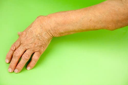 Predictieve risicofactoren voor moeilijk te behandelen RA bepaald