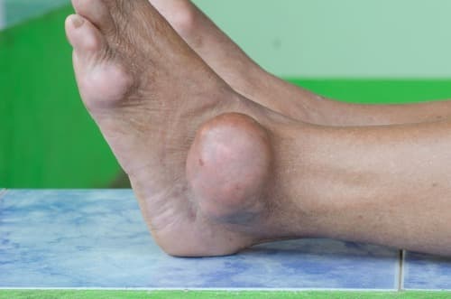 EULAR 2021: Chronische hyperinsulinemie geassocieerd met kans op jicht