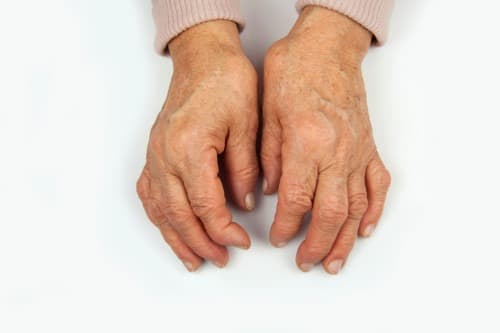 Minder NSAID’s en glucocorticoïden nodig met ivarmacitinib