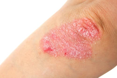 Dosisverlaging biologicals bij psoriasis haalbaar met extra inspanning