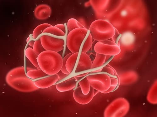 Hogere ziekteactiviteit geeft groter risico op VTE