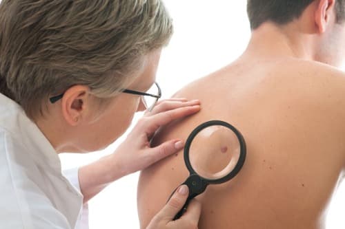 Lokale toediening van immuuntherapie bij huidkanker is haalbaar
