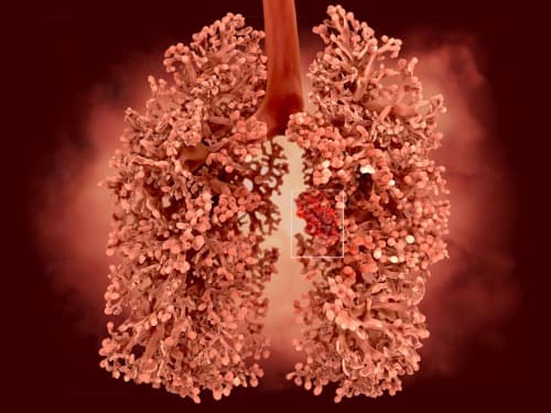 ASCO 2025: nieuwe vierdegeneratie EGFR-TKI’s onderweg voor NSCLC