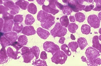 De plek van neoadjuvante chemoimmunotherapie bij NSCLC met PD-L1<1%