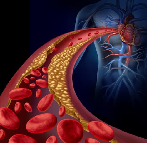 Simvastatine verlaagt frequentie van exarcerbaties bij COPD