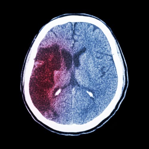 Verhoogd risico op herseninfarct bij artritis
