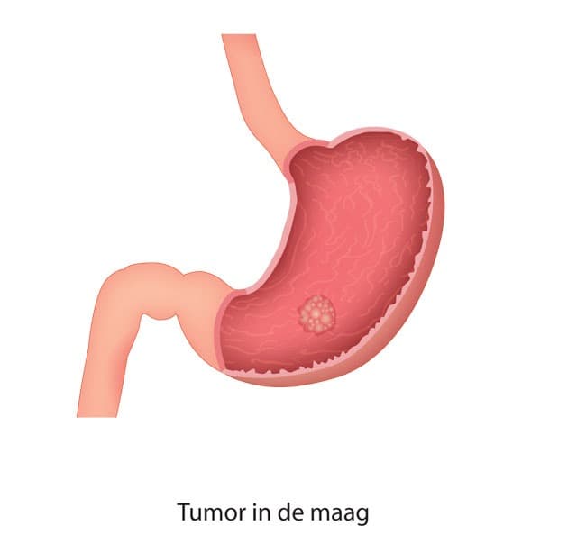 Biomarkers CEA en CA 19-9 voorspellen prognose maagkanker