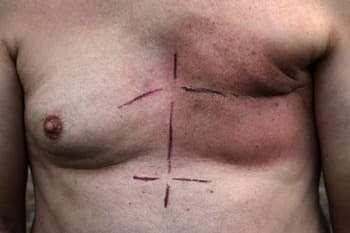 Sterk verhoogd risico op borstkanker bij mannen na Hodgkinlymfoom