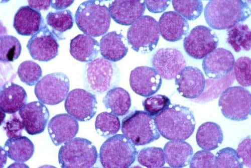 EBV geassocieerd met proliferatieve aandoeningen lymfesysteem bij RA