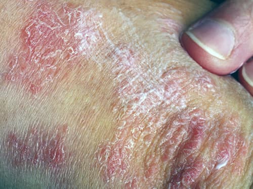 Versnellen van biomarkers voor ziekte-ernst AD en psoriasis