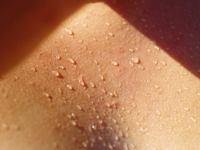 Impact of acne relapses on quality of life and productivity