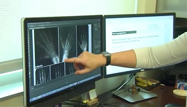 Hoger risico op fracturen bij jongere RA-patiënten