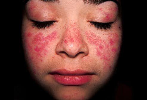 LUPUS & APS 2025: BAFF gelinkt aan longschade bij SLE-patiënten