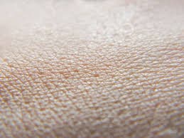 Dermatoloog en biologicals verhogen tevredenheid behandeling HS