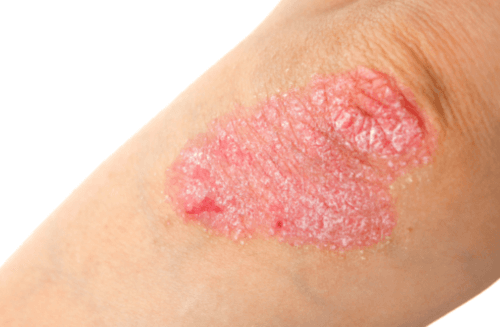 Relatie inname van ultrabewerkt voedsel en actieve psoriasis