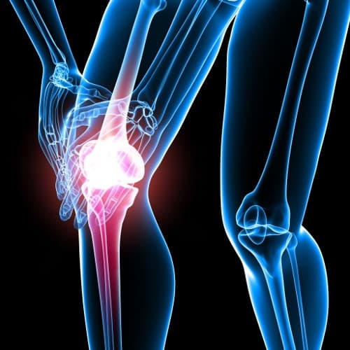 DCE-MRI geschikt voor volgen van synovitis bij knieartrose