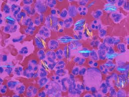 Ramanspectroscopie: nauwkeurige diagnose van gewrichtskristallen