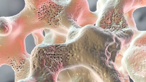 ACR 2021: Grotere botdichtheid denosumab bij glucocorticoïd geïnduceerde osteoporose of RA
