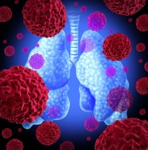 ctDNA als responsbiomarker bij immunochemoradiotherapie voor NSCLC