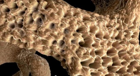 Ontwikkelingen rond behandeling van osteoporose en preventie van fracturen