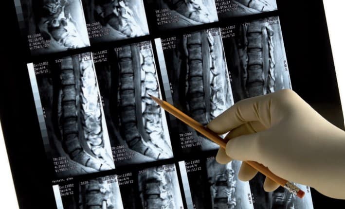 Diagnostiek van osteoporose: over meten, markers en risico inschatting