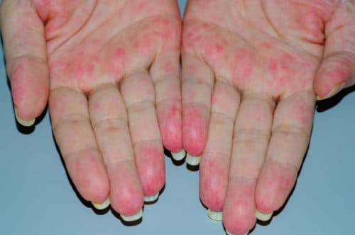 ANCA-geassocieerde vasculitis verhoogt risico op multimorbiditeit