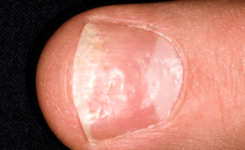CCL19+ fibroblasten als nieuwe sleutel in systemische sclerose