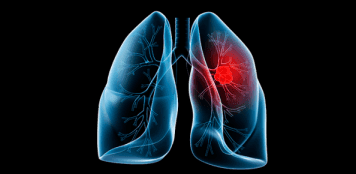 PD-1 in tumorinfiltrerende lymfocyten van prognostische waarde bij NSCLC