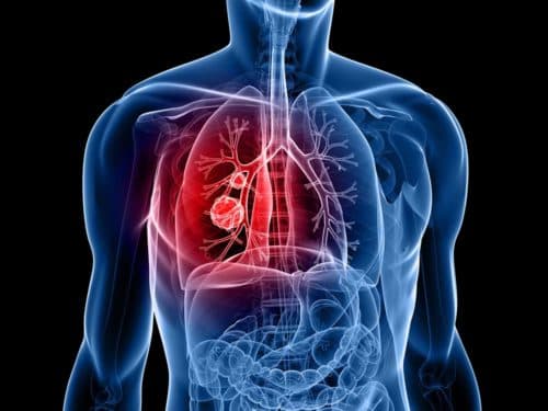 Netwerk-meta-analyse helpt kiezen behandeling voor NSCLC na falen IO