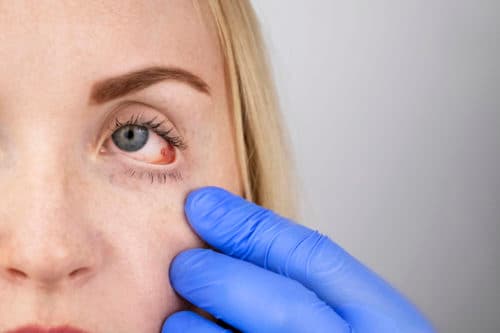 Hoger risico op acuut coronair syndroom bij AS met uveïtis