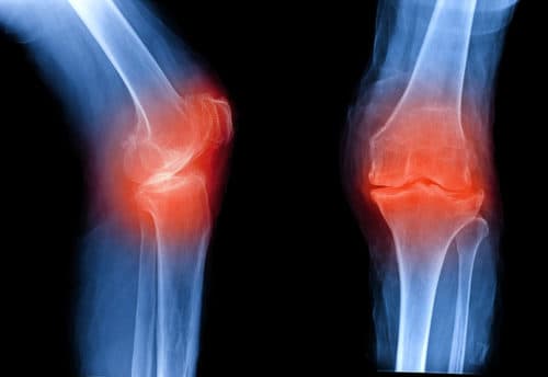 Verontreinigende stoffen mogelijk nieuwe risicofactor voor osteoartritis