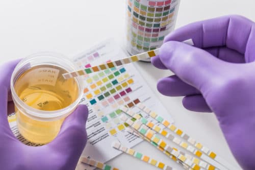 Urinetest alternatief voor MRI bij inschatten risico prostaatkanker
