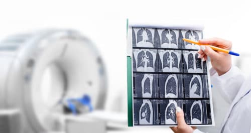 Versnelde FDA-goedkeuring voor eerste doelgerichte c-MET-therapie bij NSCLC