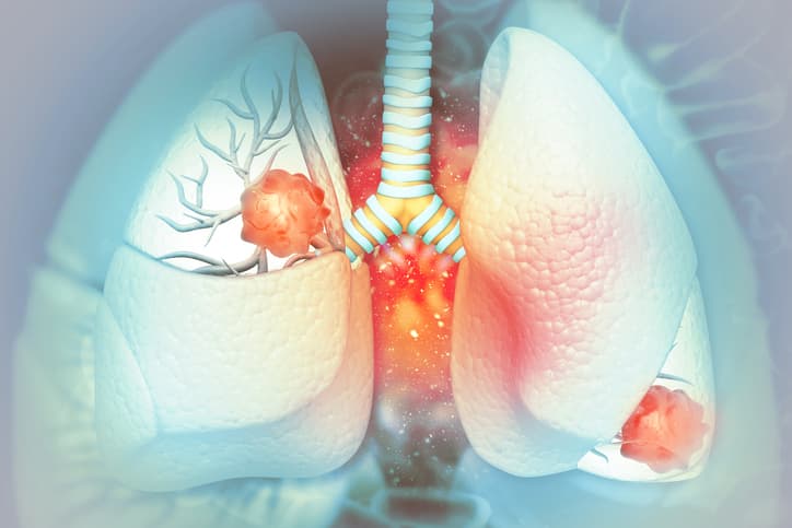 Micro-omgeving tumor mogelijke biomarker voor behandelrespons NSCLC
