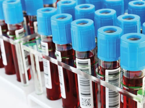 Serum MiRNA’s als nieuwe biomarkers voor diagnose van NSCLC