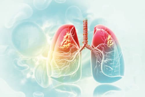 Treatable traits aanpakken nog vóór sprake is van COPD
