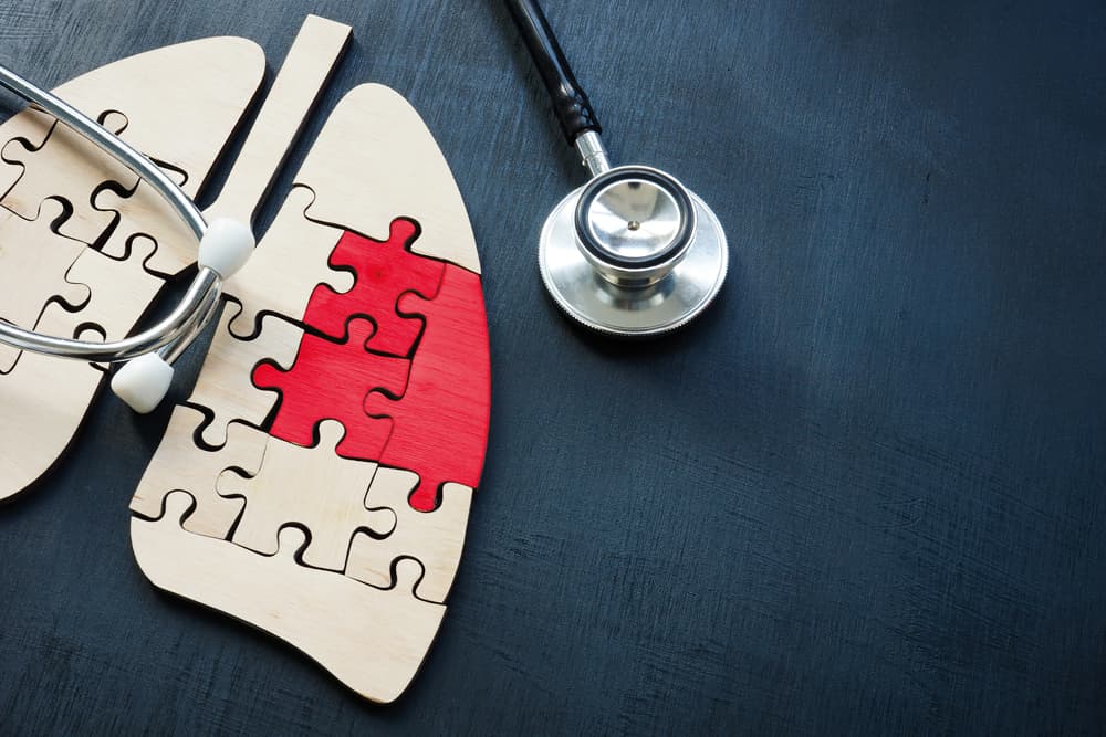 Heeft een segmentresectie de voorkeur boven een lobectomie bij NSCLC?