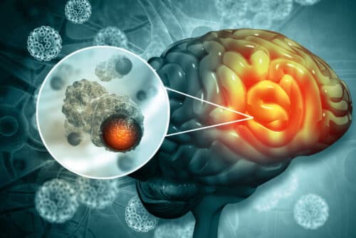 Hersenmetastasen bij NSCLC - de noodzaak van een gespecialiseerd MDO
