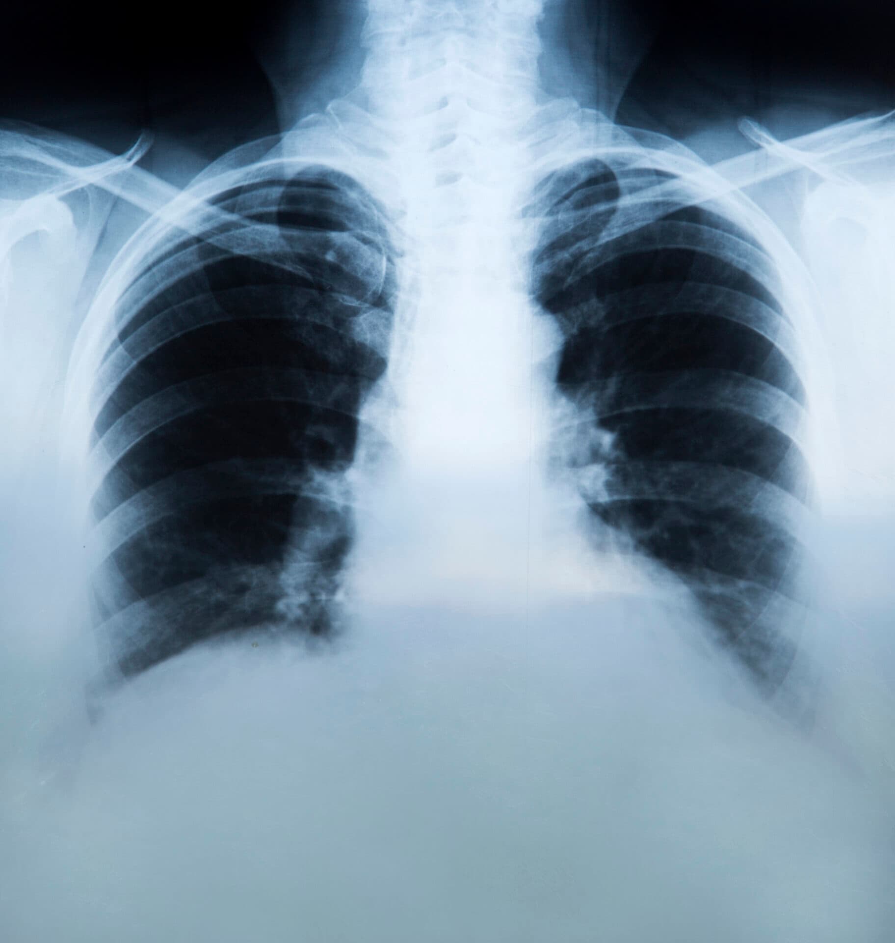 Wat is sarcoïdose? Symptomen, diagnose en behandeling